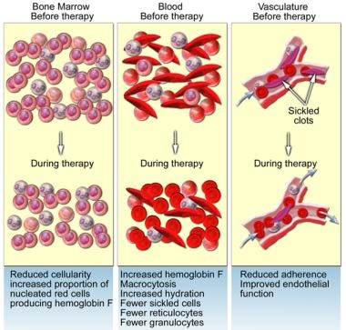 sickle cell anemia treatment disease hydroxyurea management therapy treatments transfusion effects test cure there symptoms severe stroke