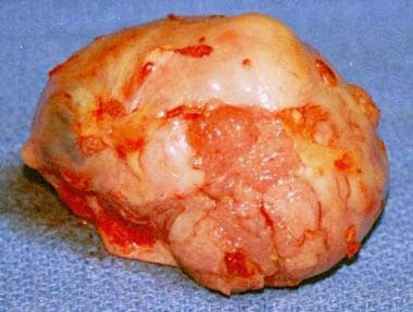 An enlarged ovary with a papillary serous carcinom