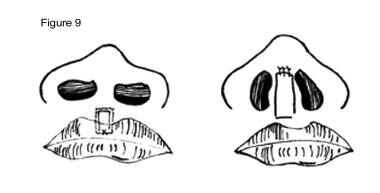 Cleft lip nasal deformity. Ferris-Smith procedure.