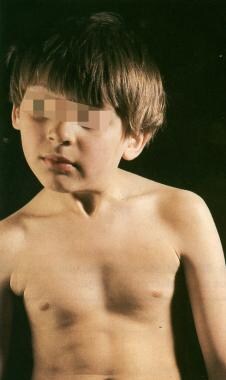 Appearance of torticollis as a result of sternomas
