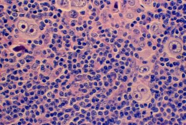 Mixed cellularity Hodgkin lymphoma showing both mo