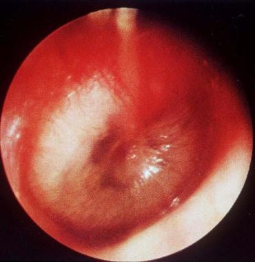 Acute otitis media with purulent effusion behind a