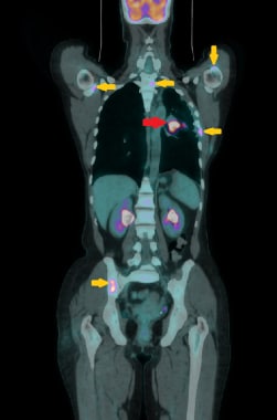 Malignant Mesothelioma Imaging: Overview, Radiography, Computed
Tomography