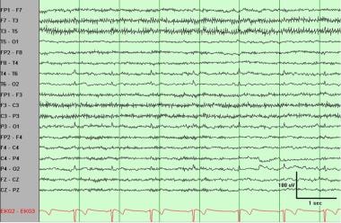 Electromyogram (muscle) artifact best observed in 