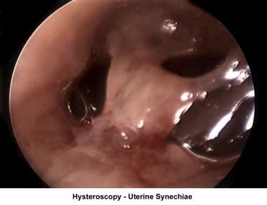 Infertility. Hysteroscopy - Uterine synechiae. Ima