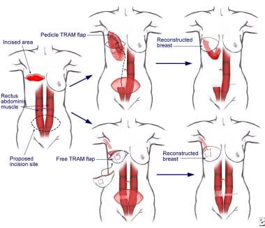 Breast cancer. Transverse rectus abdominis muscle 