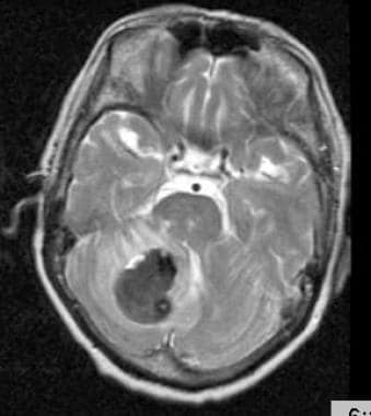 Cerebellar hemorrhage of a 62-year-old female with
