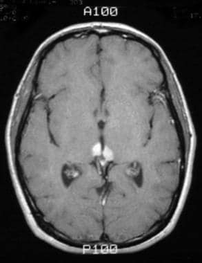 Pineal germinoma in a 30-year-old man. Axial T1-we