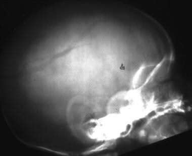 Lateral skull radiograph demonstrates a left-sided