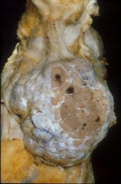 Gross appearance of a thymoma showing distinct mul