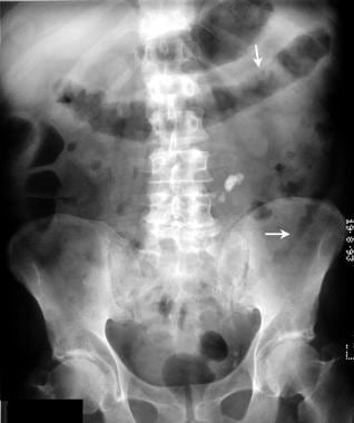 Plain supine abdominal radiograph in a 72-year-old
