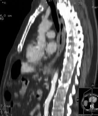 Sagittal reformatted chest CT scan demonstrates ma