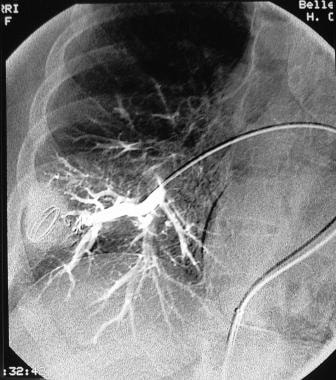 Pulmonary angiography. Image obtained after succes