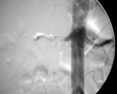 Immediate postembolization renal angiogram demonst