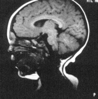 This MRI depicts a dermoid. The dermoid is intracr