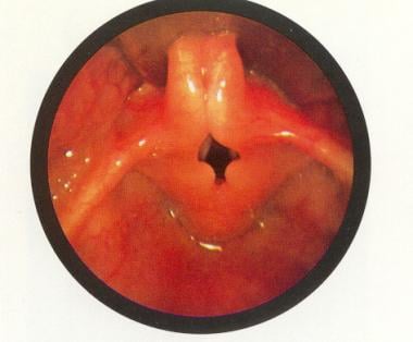 The epiglottis is small and curled on itself (omeg