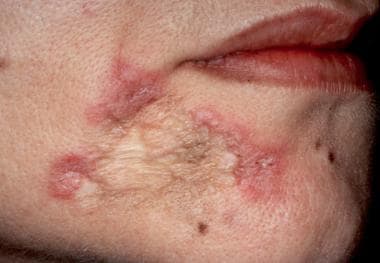 Chronic scarred lesion of discoid lupus erythemato