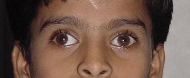 Patient with intermittent exotropia at distance on