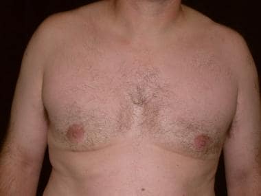 Three months postoperative after a superior cresan