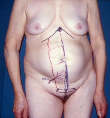 Clinical Case 4. Preoperative planning. Drawing of
