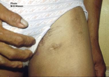 Filarial abscess scar on the left upper thigh in a