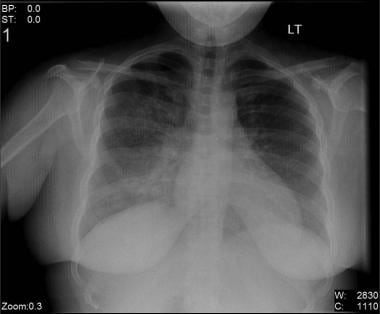 Bilateral interstitial infiltrates in a 31-year-ol