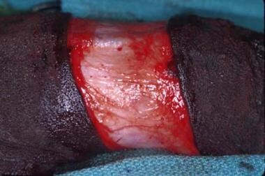 In the sleeve technique, the circumcision is start