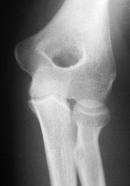 Radial head fracture. 