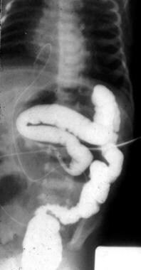 Pediatric Small Bowel Obstruction. This imaged is 