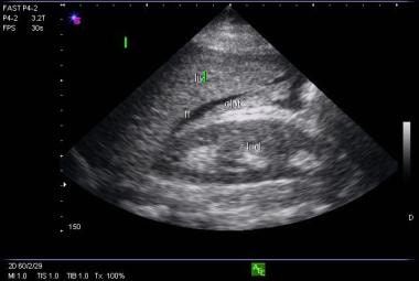 Free fluid in the Morison pouch from a ruptured ec