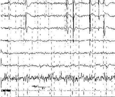 Irregularly repetitive spikes recorded at the dist