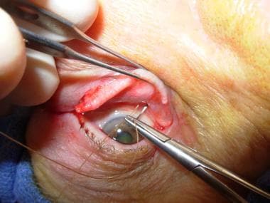 Full-thickness eyelid sutures are passed from conj