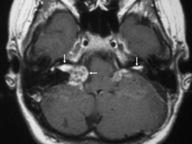 Bilateral vestibular schwannomas. Axial contrast-e