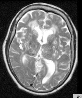 T2-weighted MRI through the thalami of a hypertens