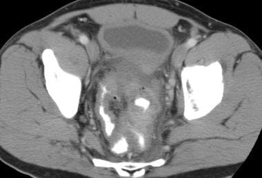 CT scan in a patient with diverticulitis demonstra
