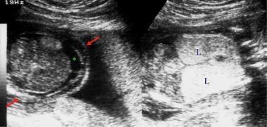 
Left: Transverse section of the fetal abdomen. Ri