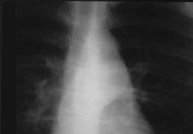 Aorta, trauma. Chest radiograph shows a chronic is