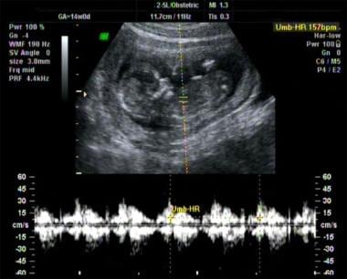 Fetal heartbeat at 20 weeks' gestation. 