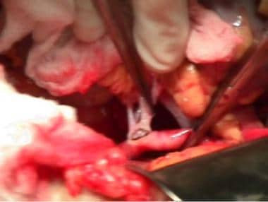End-to-side anastomosis between donor main renal a