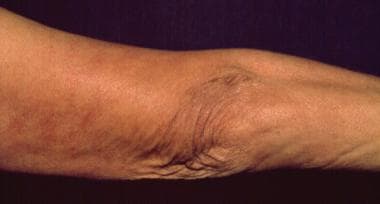 The atrophic skin lesions and fibrotic nodules of 