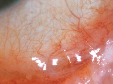 Ocular cicatricial pemphigoid, stage II. Note the 