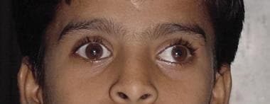 Patient with intermittent exotropia at distance on