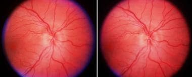 Anterior ischemic optic neuropathy of the right ey
