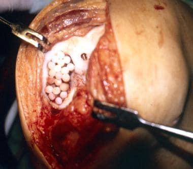 Lesions of the femoral condyle up to 8.5 cm2 have 