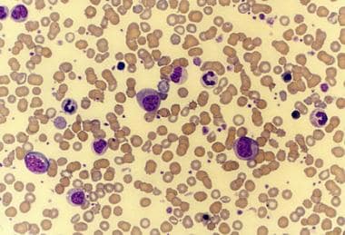 Peripheral smear of a patient with agnogenic myelo