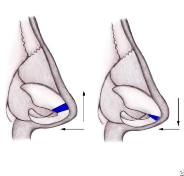 Dome division to narrow the nasal tip: Division an