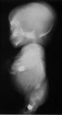 Lateral view radiograph of an infant with achondro