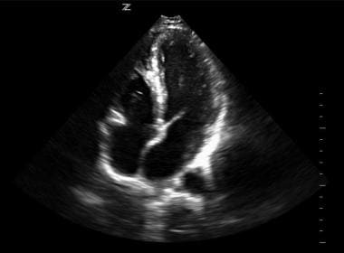 Normal ultrasound image of apical 4-chamber view. 