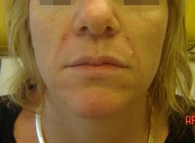 Patient 2. After photo. Dr. Bader injected Restyla