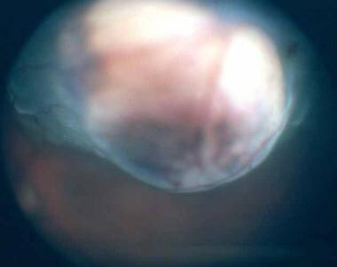 Transpupillary photograph showing a posterior chor